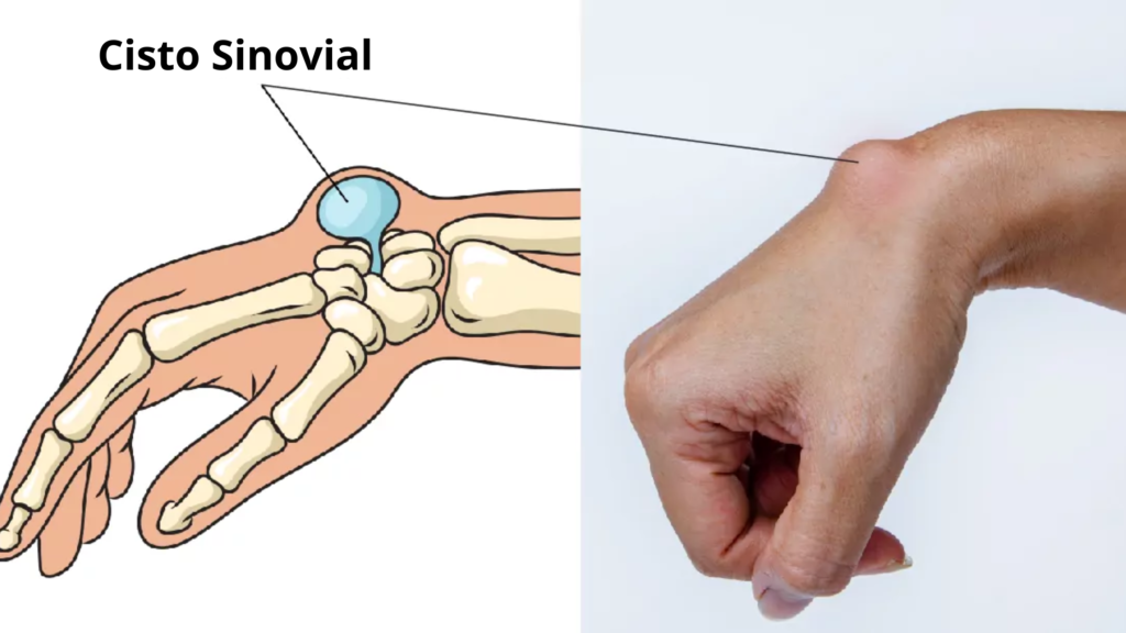 Cisto Sinovial no Pulso: 4 Causas, Sintomas e Tratamentos 1 Cisto sinovial no pulso