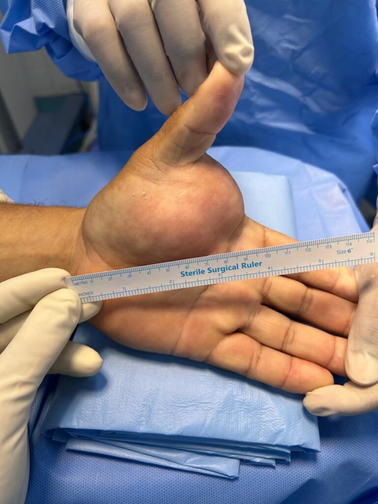 tumor benigno na mao