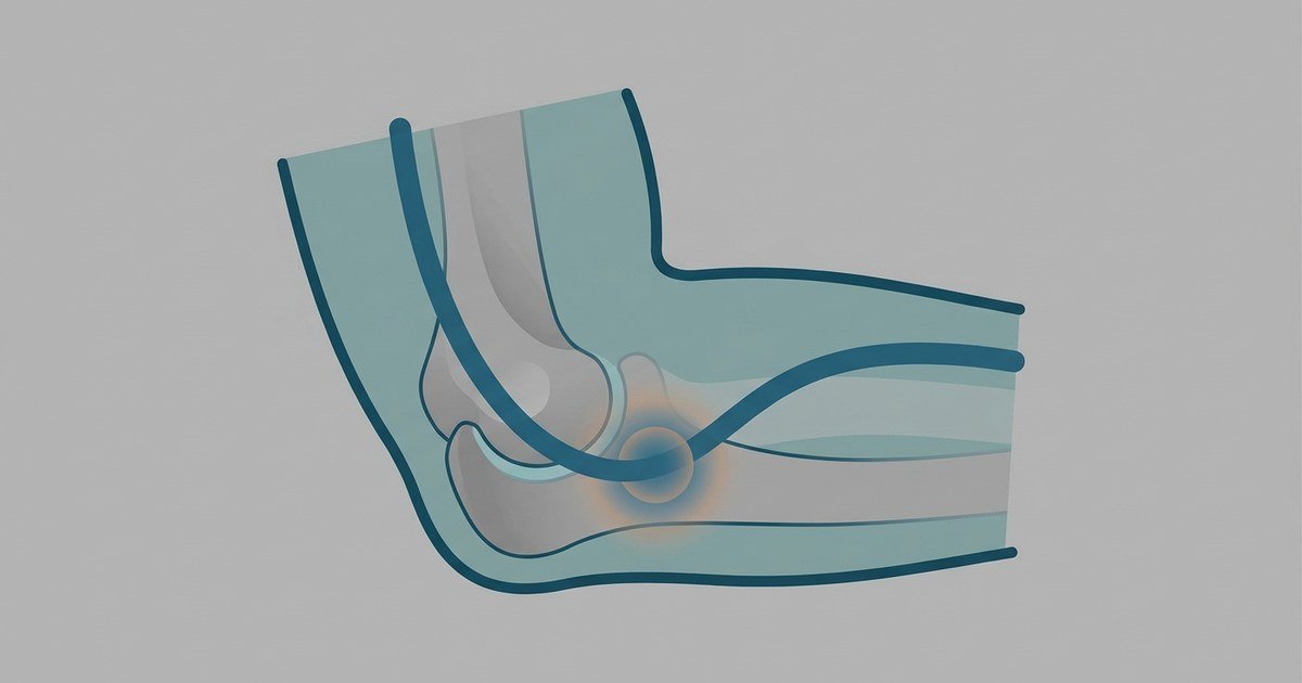 Síndrome do túnel cubital: ilustração médica do cotovelo com o nervo ulnar comprimido no túnel cubital, vista medial, com destaque para o epicôndilo medial e o olécrano